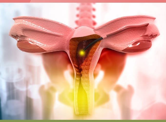 Hysteroscopy