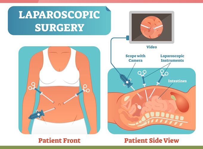 Risks associated with Laparoscopy