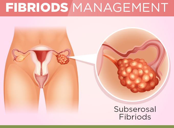 fibroids management