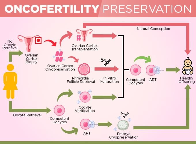Oncofertility Preservation