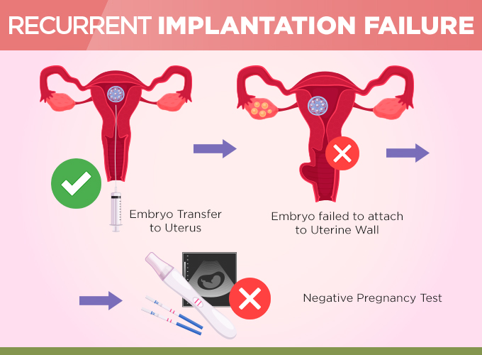recurrent implantation failure